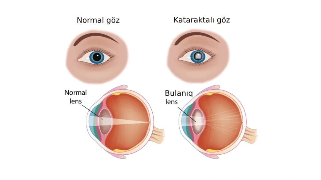 katarakta göz xəstəliyi