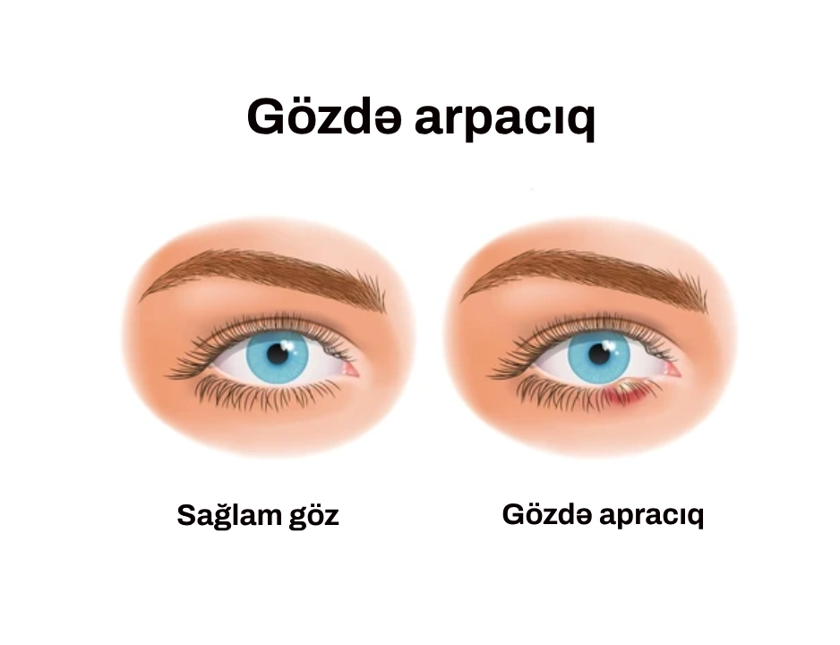 gözdə arpacıq