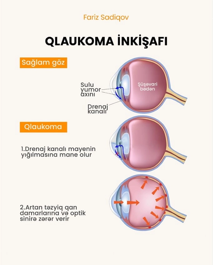 Qlaukoma inkişafı