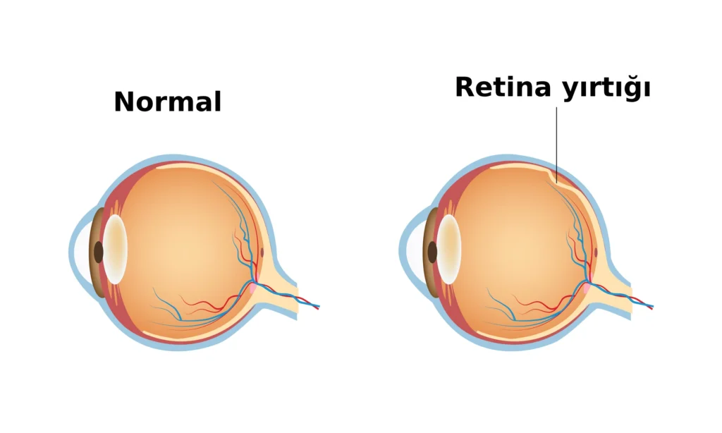 retina yırtığı
