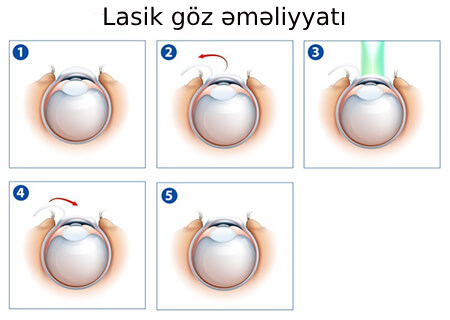 lasik göz əməliyyatı